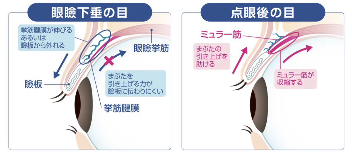 アップニーク®ミニ点眼液0.1％
